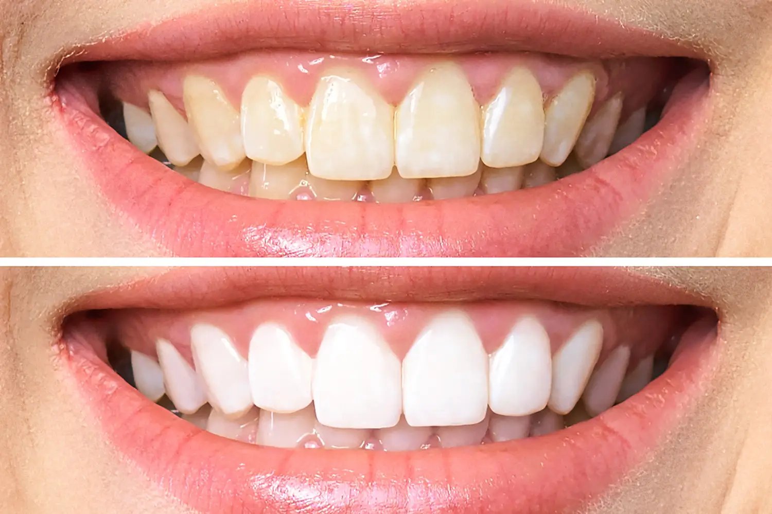 טיפול להלבנת שיניים בבית באמצעות סדי הלבנה