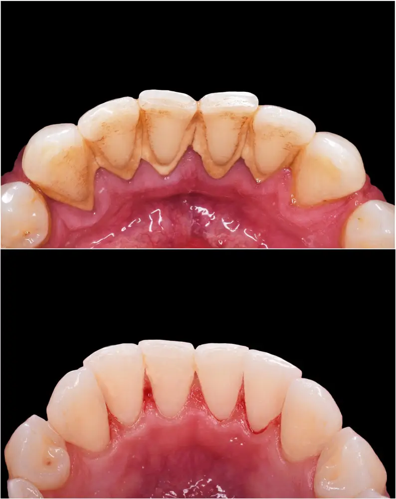 לפני ואחרי ניקוי שיניים אצל שיננית